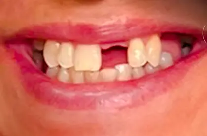 Sorriso antes do clareamento dental