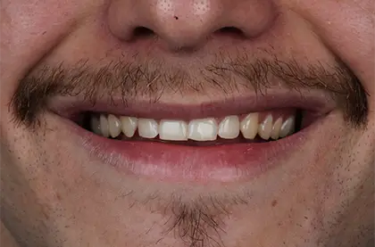 Sorriso masculino antes do clareamento dental