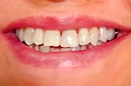 Sorriso depois do clareamento dental