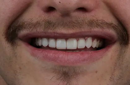 Sorriso masculino depois do clareamento dental